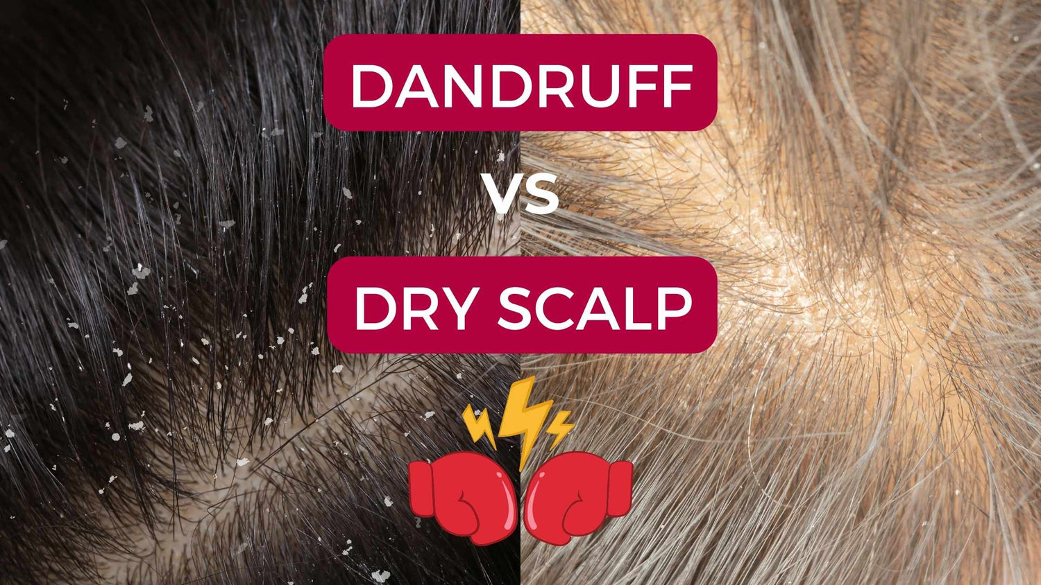 dandruff vs dryl scalp blog